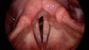 Tell us your favorite pick from our list of healthy drinks for kids and also share your nutritious recipes in the comment section below. Smoker S Throat Vs Healthy Throat Visual Comparison Amara