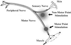 neuromuscular electrical stimulation in critically ill