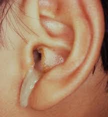 What i had to do. Ear Discharge Ear Infection Ent Specialist Singapore