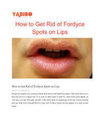 Fordyce spots are a natural phenomenon. How To Get Rid Of Fordyce Spots On Lips By Ankithaanu Issuu