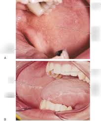 Image result for Labial mucosa