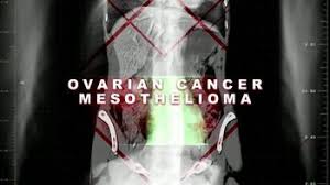 Sellas reports promising data from combination trials in ovarian cancer and mesothelioma. The Driscoll Firm Tv Commercial Ovarian Cancer Or Mesothelioma Ispot Tv