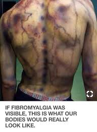 Pin On Fibromyalgia