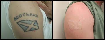 Medical spas, laser hair removal, tattoo removal. Laser Tattoo Removal In Milwaukee Wi Laserfied