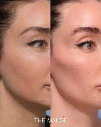 Am i a good candidate for cheek fillers? Cheek Fillers Before And After Sydney Dermal Filler Clinic