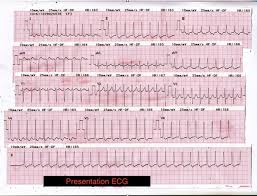 Paroxysmal supraventricular tachycardia (svt, psvt). A Case Of Supraventricular Tachycardia Associated With Wolff Parkinson White Syndrome Chee Journal Of Medical Cases