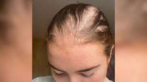 Medical Wigs For Hair Loss & Illness ...