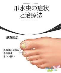 家庭でできる爪真菌症治療 家庭でできる爪真菌症治療 白癬 水虫 水虫治療