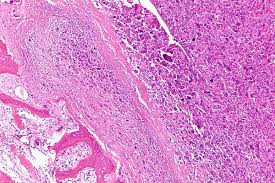 We believe dogs and their families should not have to battle this disease alone. Osteosarcoma Wikipedia