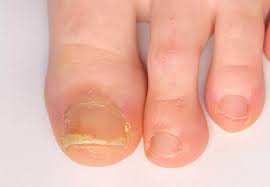 Image result for Pitting nails feet