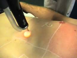 Hommes comme femmes souhaitent avoir une peau lisse et douce. Epilation Laser Definitive Torse Ventre Homme Rouen Proche Evreux 27 Le Havre76 Dr Nathan Yadun Youtube
