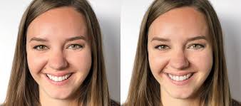 ᐅ Tratamiento de Ortodoncia Invisible Estética en Bogotá