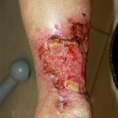 Martorell hypertensive ischemic ulcer successfully treated with punch skin grafting. Martorell Ulcer