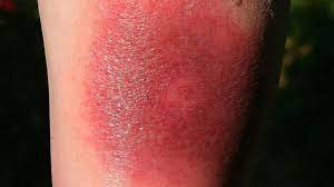 Was ist nach einem zeckenbiss zu beachten? Zeckenbiss Rotung Darum Sollten Sie Bei Einer Wanderrote Schnell Zum Arzt Gesundheit