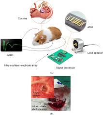 A cochlear implant (ci) is a surgically implanted neuroprosthetic device to provide a person with moderate to profound sensorineural hearing loss a modified sense of sound. A Microelectromechanical System Artificial Basilar Membrane Based On A Piezoelectric Cantilever Array And Its Characterization Using An Animal Model Scientific Reports