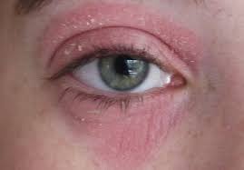 How I Got Rid Of My Eye Eczema Dry Skin Around Eyes Eye Eczema Dry Flaky Skin