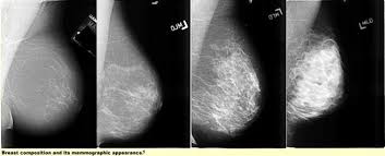 Do you believe your eating habits to be healthy? Digital Breast Tomosynthesis And Breast Cancer Screening Definition