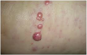 Image result for Merkel Cell Carcinoma