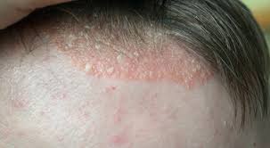 اكزيما الشعر أسبابها وطرق علاجها ويب طب