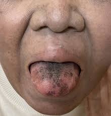 Image result for black tongue symptoms