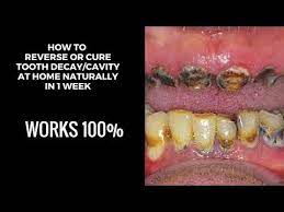 Natural Remedies For Cavities How To Reverse Tooth Decay Home Remedies For Cavities Heal Cavities Youtube Cure Tooth Decay Heal Cavities Tooth Decay Remedies