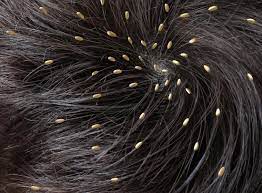 Clinical team members, such as registered nurses (rns), radiologic technicians (rts) and medical assistants, play a critical role at every medexpress center. Head Lice Causes Symptoms And Treatments