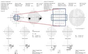 10 2 Visual Field Testing A Tool For All Glaucoma Stages