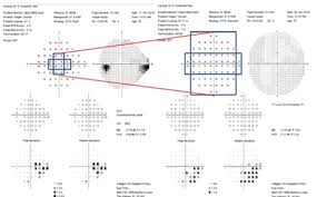 10 2 visual field testing a tool for all glaucoma stages