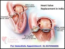 Heart Valve Replacement Surgery Cost In India Top Surgeons And Best Hospitals Of India Heart Valves Best Hospitals Valve