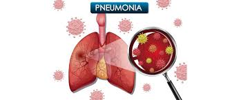 Image result for Pneumonia