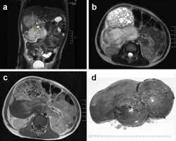 Mri Shows A Large Tumor In The Right Upper Abdomen Originating From The Download Scientific Diagram