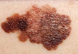 It is better to look out for any changes on the skin to detect the growth of cancer causing cells as early as possible. Melanoma Wikipedia