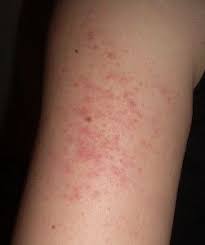 Home Remedies For Razor Bumps Keratosis Pilaris Treat Keratosis Pilaris Skin Bumps