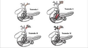 Yuki tsunoda seemed to come from nowhere in the second half of the f3 season, but his progress had been a long time in the making. Clasificacion Endoscopica De La Hepatolitiasis Segun Tsunoda Tomado De Download Scientific Diagram