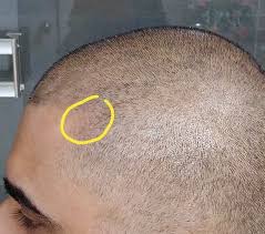 Your truly caring laser and beauty clinic in sydney. Is This Hyperpigmentation Permanent Following Laser Hair Removal After Smp Photo