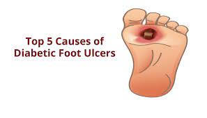 Below are some of the most common causes of diabetic foot ulcers. Top 5 Causes Of Diabetic Foot Ulcers Dr Abhilash