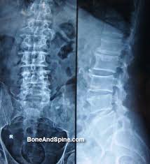Lumbar Spondylosis - Causes, Presentation and Treatment | Bone and Spine