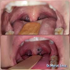 Image result for papillomavirus tongue)