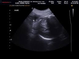 3d 4d baby ultrasound and photography also offers early gender dna detection tests offered to women starting at 9 weeks into pregnancy. Ultrasound Hair Vs Hair At Birth Glow Community