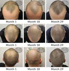 Farah says minoxidil is a common option for hair loss treatment that doesn't require a prescription. Hair Growth Success Staff Are Very Helpful And Friendly
