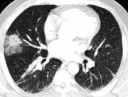 Laboratory diagnosis of invasive aspergillosis: Ct Findings And Differential Diagnosis In Adults With Invasive Pulmonary Aspergillosis Sciencedirect