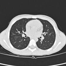 If lung cancer runs in your family, genes may not be the only reason. Rhabdomyosarcoma Are Spots On The Lung Dangerous Healthcare In Europe Com
