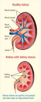 Jessianna saville, rdn, a renal dietitian published an article for the national kidney foundation on this topic, and warned that drinking too much coffee comes with other risks, but said it was an. Kidney Stones Guide Causes Symptoms And Treatment Options