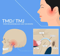 The tmj region was not examined. Botox For Tmj Relief Blog Beauty Tips Introlift Medical Spa