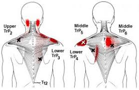 what are trigger points triggerpointselfhelp com