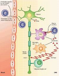 A population based study of multiple sclerosis in twins: Hospital Italiano De Buenos Aires