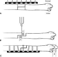 What can i use instead of shortening? Step Cut Distal Ulnar Shortening Osteotomy Journal Of Hand Surgery