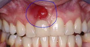 Pin On Embarrassing Pimples