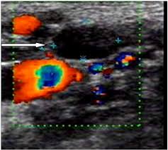 A small device called a transducer is moved over the area. Local Metastasis In Head And Neck Cancer An Overview Intechopen