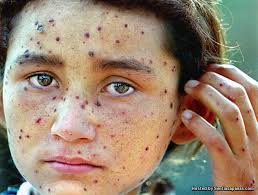 Ramai dikalangan masyarakat yang keliru dengan istilah demam campak dengan cacar air(chicken pox). Apa Itu Cacar Air Dan Pantang Larangnya Sentiasa Panas